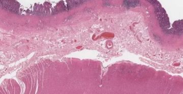 Субатрофический гастрит Субатрофический гастрит