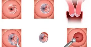 Лечение ВПЧ и прижигание эрозии шейки матки