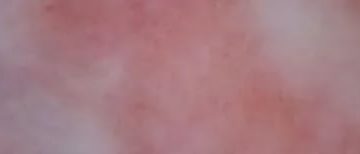 Сухость головки члена и красное пятно