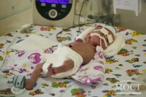 Кесарево 30 недель беременности