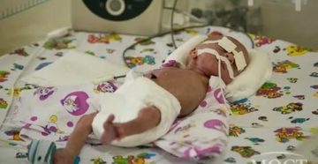 Кесарево 30 недель беременности