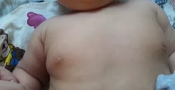 Покраснел один сосок у девочки 9 лет