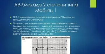 Блокада 2 степени Мобиц 1, 2