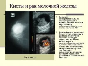 Киста или рак?