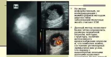Киста или рак?