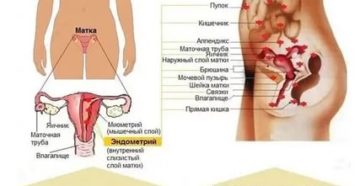 Эндометриоз и постоянные боли