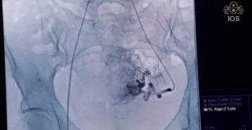 Миома матки и сахарный диабет и давление