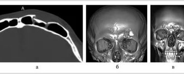 Консолидированный перелом костей носа, перелом передней стенки лобных пазух