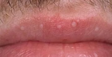 Стоматит на половой губе Стоматит на половой губе