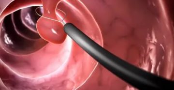 Полип, или нет?