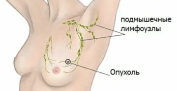 Фиброаденома, болит подмышкой, плечо