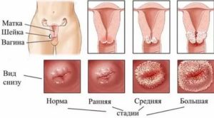 Боль в пояснице, впч, эрозия