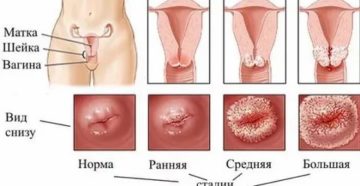 Боль в пояснице, впч, эрозия