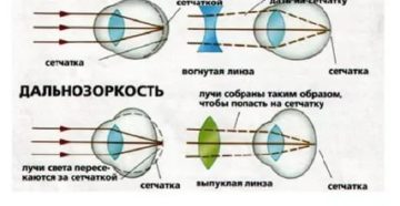 Дальнозоркость перешла в близорукость