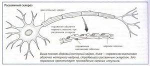 Рассеяный склероз или ВСД?