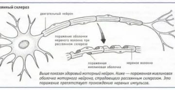 Рассеяный склероз или ВСД?