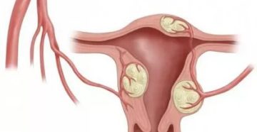 Можетли быть у девственниц миома и это лечится?