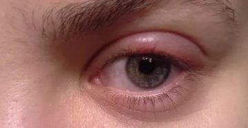 Боль, припухлость верхнего века и уголка глаза