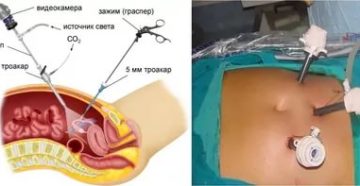 Лапароскопия или ГСГ после внематочной беременности