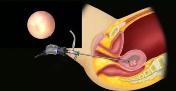 Половая жизнь после гистероскопии