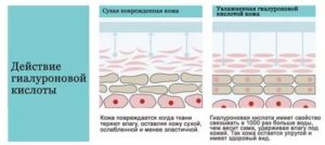 Инъекции гиалуроновой кислоты в гинекологии