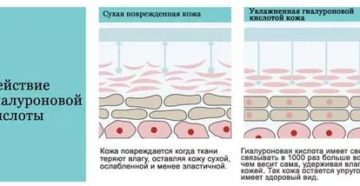 Инъекции гиалуроновой кислоты в гинекологии