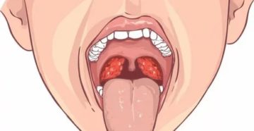 Большая миндалина Большая миндалина