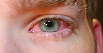 Покраснели оба глаза после капель Покраснели оба глаза после капель