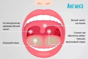 Постоянно болит горло, белый налет
