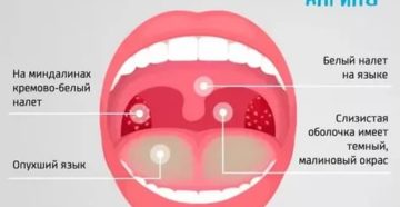 Постоянно болит горло, белый налет