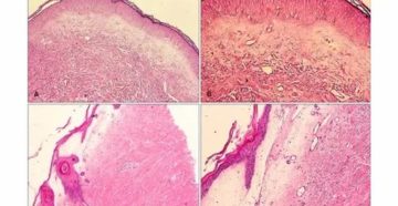 Можно ли остановить развитие крауроза?