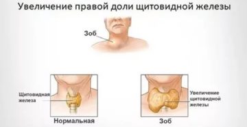 Увеличена левая доля щитовидки