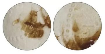 Коричневые выделения в середине цикла после удаления полипа