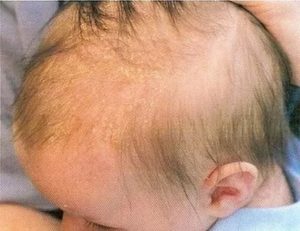 Корочки и шелушение на голове у ребенка
