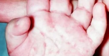 Непроходящая чесотка у ребенка