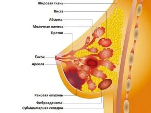 Уплотнение в верхней части груди