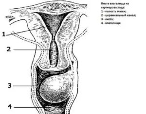 Киста влагалища