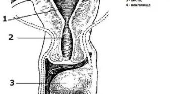 Киста влагалища
