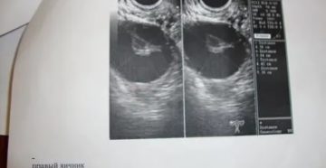 Киста правого яичника и задержка