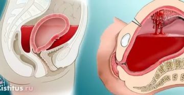 Кровотечение через месяц после родов