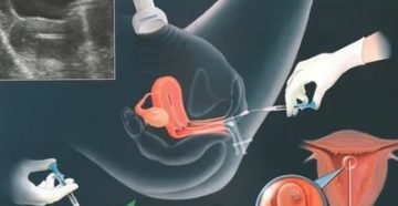 Подсадка эмбрионов во время кашля