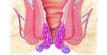 Боль в лимфоузле и образование геморроя