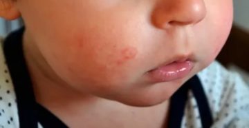 Пятно на лице у ребенка