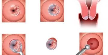 Можно ли сидеть после конизации