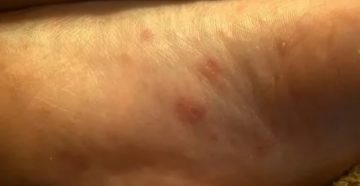 Пятно на стопе на подошве Пятно на стопе на подошве