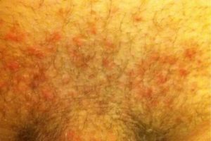 Увеличенные паховые лимфоузлы, высыпания на половых губах, молочница