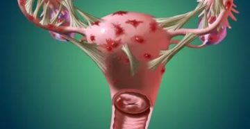 Киста яичника и полип