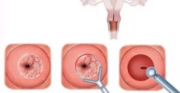 Лейкоплакия шейки матки и эктопия. Результаты биопсии