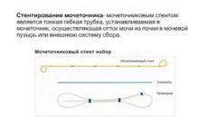 Выбор стента для мочеточника