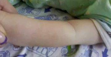 Пятно на ручке у ребёнка Пятно на ручке у ребёнка